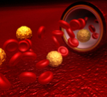 טרשת עורקים: חסימת כלי דם-תמונה